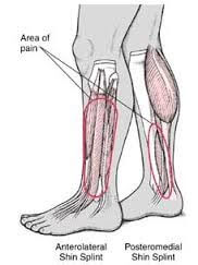 anterolateral shin splint