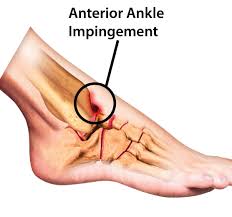 Clinical Prediction Rule For Anterolateral Ankle Impingement