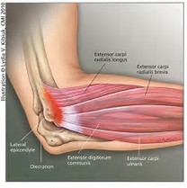 tennis elbow; lateral epicondylitis, lateral epicondyalgia