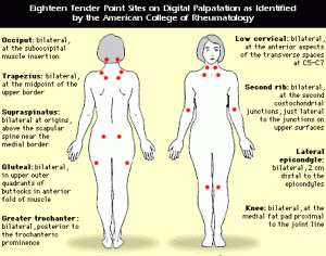 Болезненные точки при фибромиалгии фото